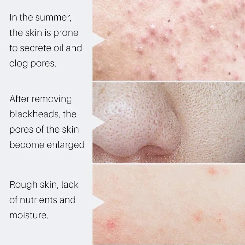 Salicylic Acid Pore Shrinking  - Salicylic Acid Blackhead Remover recension och pris